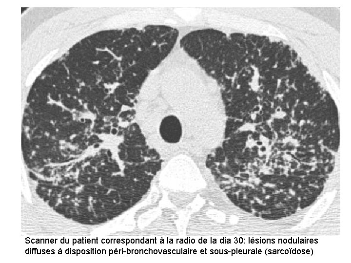 Scanner du patient correspondant à la radio de la dia 30: lésions nodulaires diffuses Scanner du patient correspondant à la radio de la dia 30: lésions nodulaires diffuses