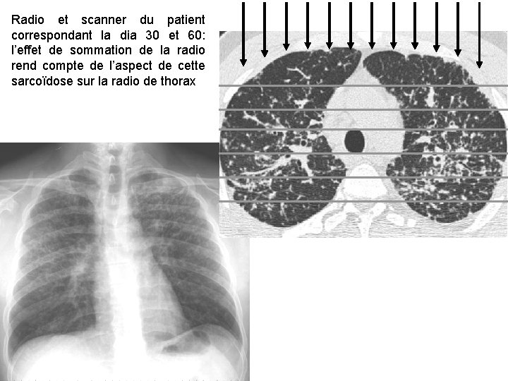 Pr Marquette 2011 Radio et scanner du patient correspondant la dia 30 et 60: Pr Marquette 2011 Radio et scanner du patient correspondant la dia 30 et 60: