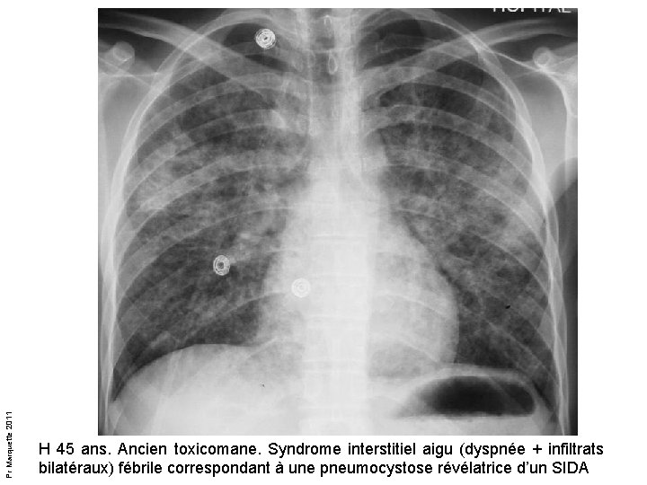 Pr Marquette 2011 H 45 ans. Ancien toxicomane. Syndrome interstitiel aigu (dyspnée + infiltrats Pr Marquette 2011 H 45 ans. Ancien toxicomane. Syndrome interstitiel aigu (dyspnée + infiltrats