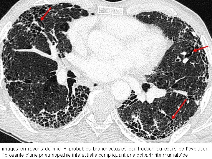 images en rayons de miel + probables bronchectasies par traction au cours de l’évolution images en rayons de miel + probables bronchectasies par traction au cours de l’évolution