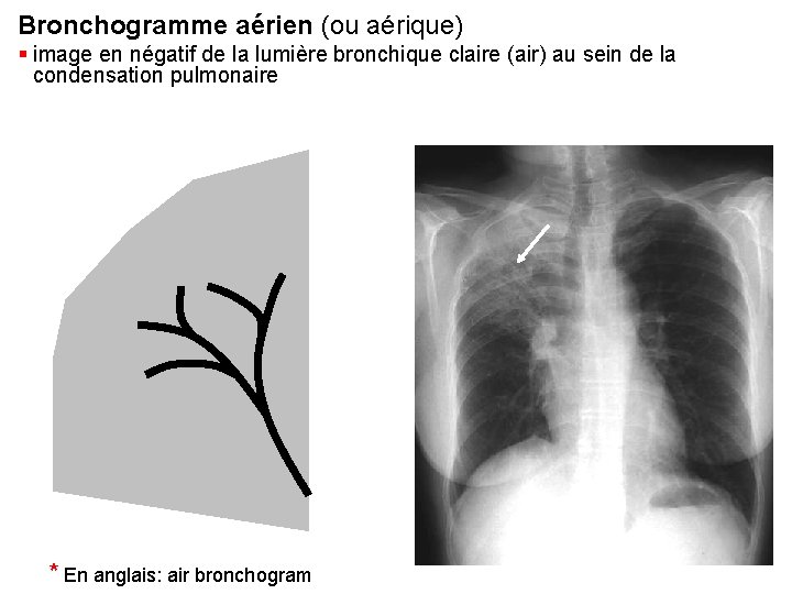 Bronchogramme aérien (ou aérique) § image en négatif de la lumière bronchique claire (air) Bronchogramme aérien (ou aérique) § image en négatif de la lumière bronchique claire (air)