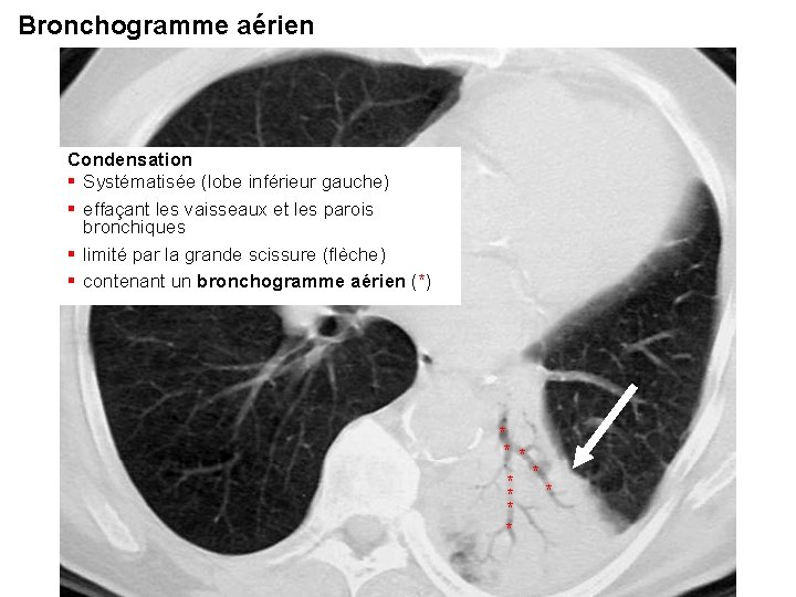 Bronchogramme aérien Condensation § Systématisée (lobe inférieur gauche) § effaçant les vaisseaux et les Bronchogramme aérien Condensation § Systématisée (lobe inférieur gauche) § effaçant les vaisseaux et les