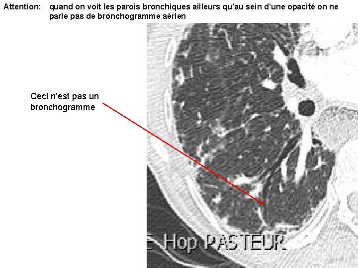 Attention: quand on voit les parois bronchiques ailleurs qu’au sein d’une opacité on ne Attention: quand on voit les parois bronchiques ailleurs qu’au sein d’une opacité on ne