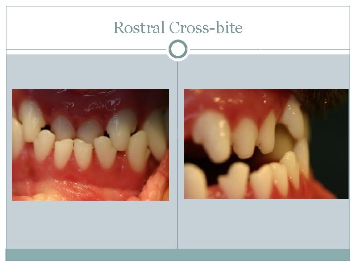 Rostral Cross-bite 