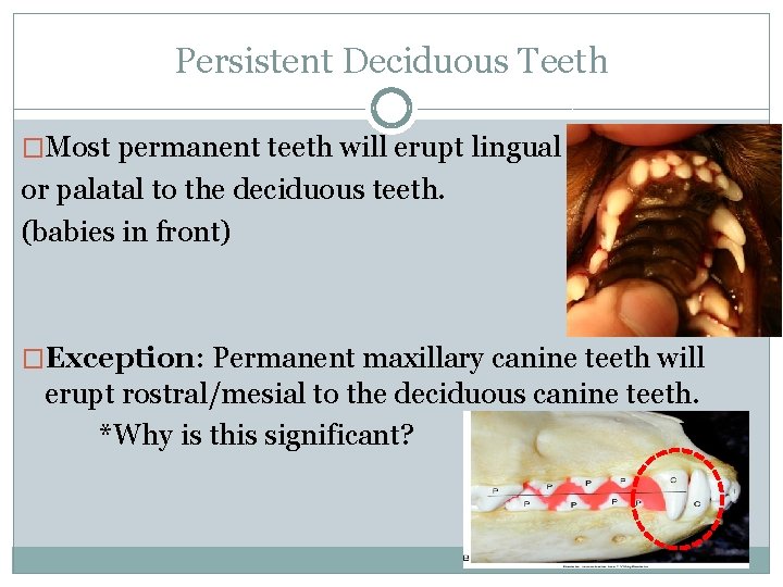 Persistent Deciduous Teeth �Most permanent teeth will erupt lingual or palatal to the deciduous