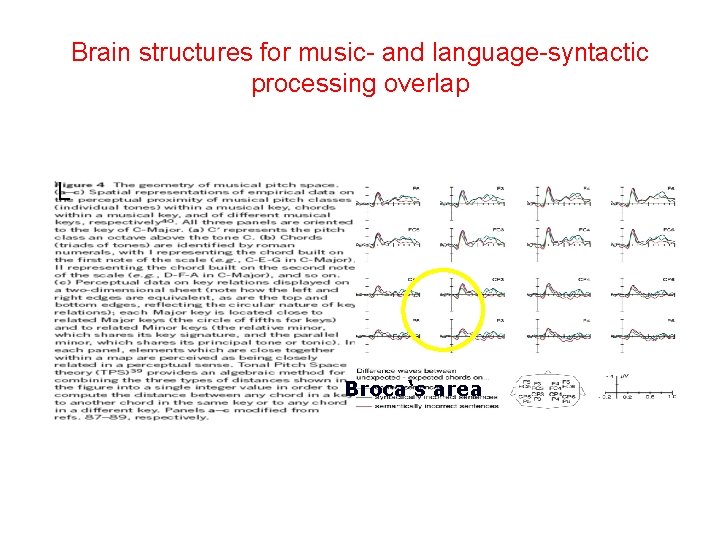 Brain structures for music- and language-syntactic processing overlap L Broca‘s area 