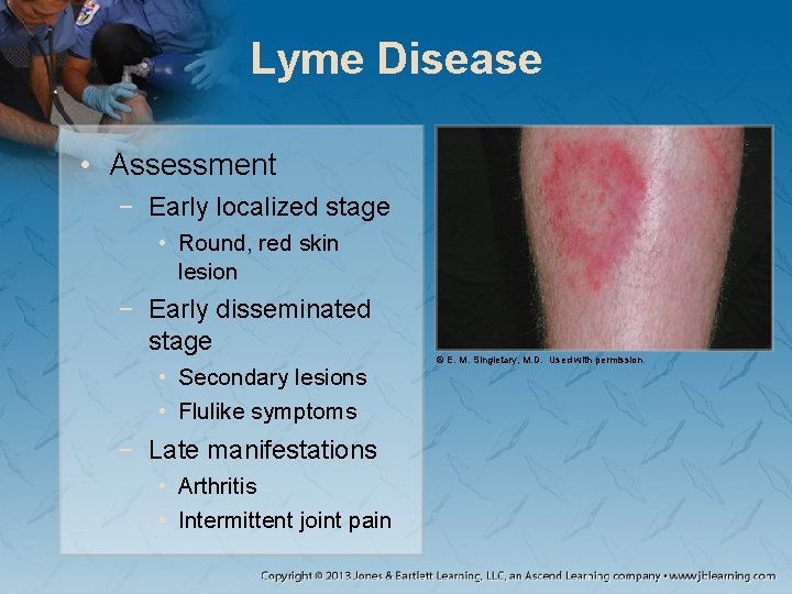 Lyme Disease • Assessment − Early localized stage • Round, red skin lesion −