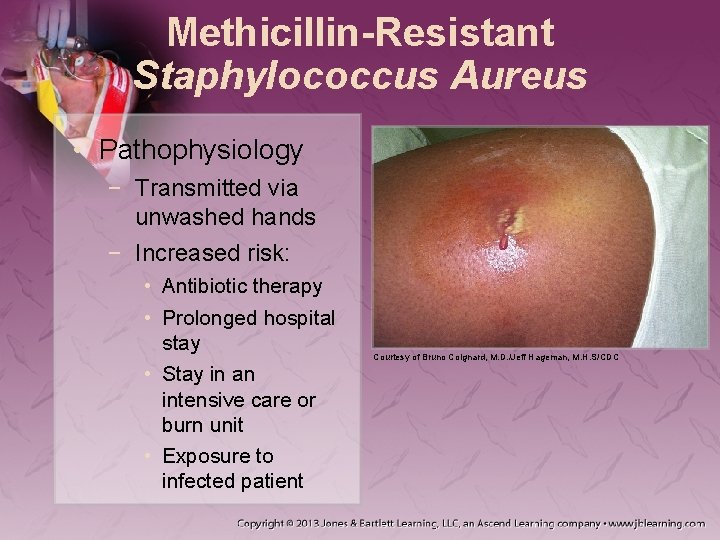 Methicillin-Resistant Staphylococcus Aureus • Pathophysiology − Transmitted via unwashed hands − Increased risk: •