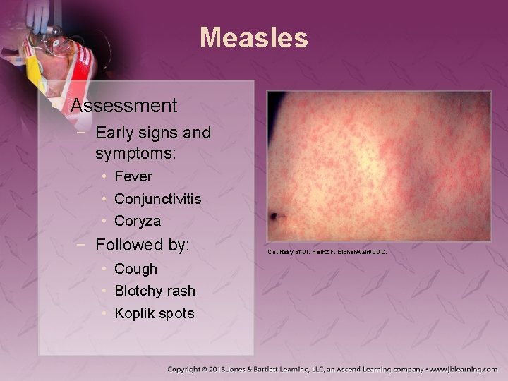 Measles • Assessment − Early signs and symptoms: • Fever • Conjunctivitis • Coryza