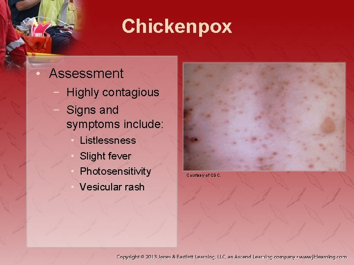 Chickenpox • Assessment − Highly contagious − Signs and symptoms include: • • Listlessness