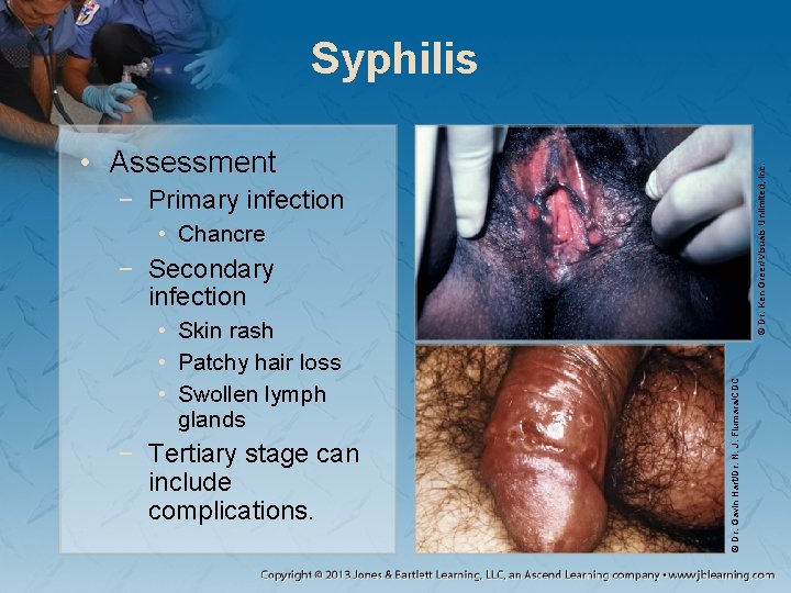 Syphilis © Dr. Ken Greer/Visuals Unlimited, Inc. • Assessment − Primary infection • Chancre