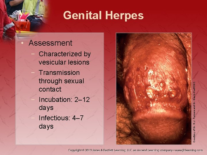 Genital Herpes − Characterized by vesicular lesions − Transmission through sexual contact − Incubation: