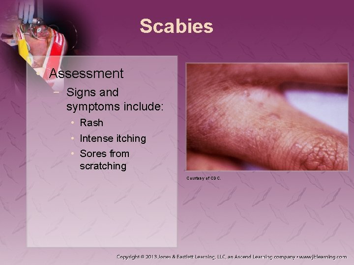 Scabies • Assessment − Signs and symptoms include: • Rash • Intense itching •