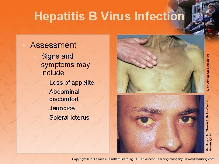 Hepatitis B Virus Infection • Loss of appetite • Abdominal discomfort • Jaundice •