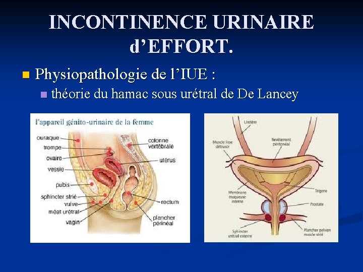 INCONTINENCE URINAIRE d’EFFORT. n Physiopathologie de l’IUE : n théorie du hamac sous urétral