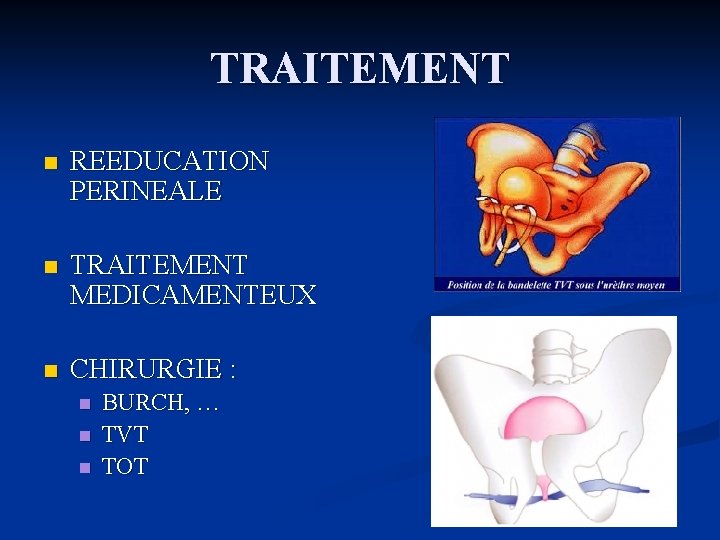 TRAITEMENT n REEDUCATION PERINEALE n TRAITEMENT MEDICAMENTEUX n CHIRURGIE : n n n BURCH,