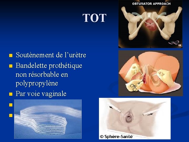 TOT n n n Soutènement de l’urètre Bandelette prothétique non résorbable en polypropylène Par