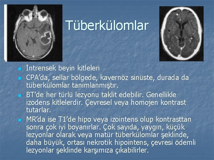 Tüberkülomlar n n İntrensek beyin kitleleri CPA’da, sellar bölgede, kavernöz sinüste, durada da tüberkülomlar