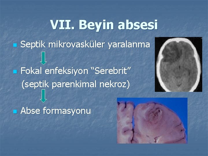 VII. Beyin absesi n n n Septik mikrovasküler yaralanma Fokal enfeksiyon “Serebrit” (septik parenkimal