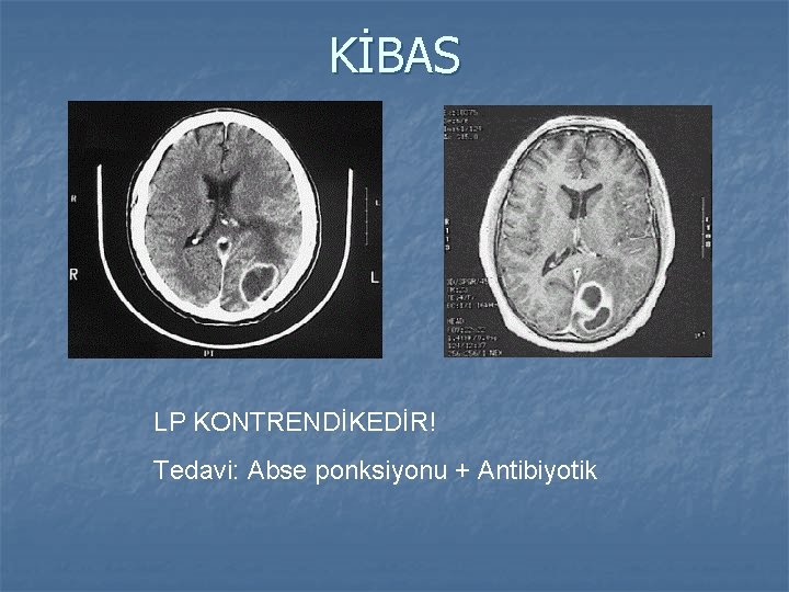 KİBAS LP KONTRENDİKEDİR! Tedavi: Abse ponksiyonu + Antibiyotik 