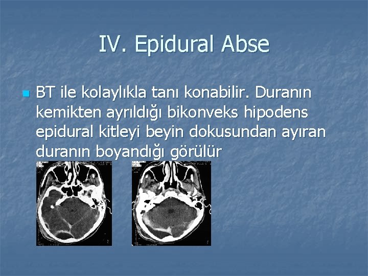 IV. Epidural Abse n BT ile kolaylıkla tanı konabilir. Duranın kemikten ayrıldığı bikonveks hipodens