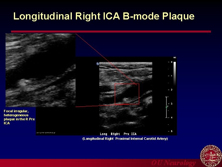 Longitudinal Right ICA B-mode Plaque Focal irregular, heterogeneous plaque in the R Prx ICA