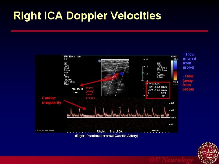 Right ICA Doppler Velocities + Flow (toward from probe) Patient’s Head Cardiac irregularity Flow