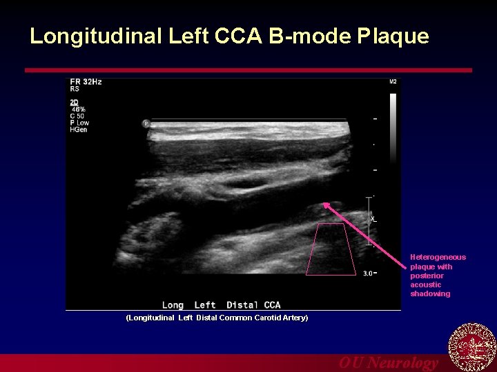 Longitudinal Left CCA B-mode Plaque Heterogeneous plaque with posterior acoustic shadowing (Longitudinal Left Distal