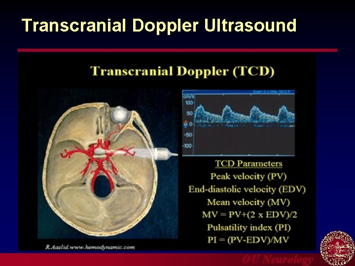 Transcranial Doppler Ultrasound OU Neurology 