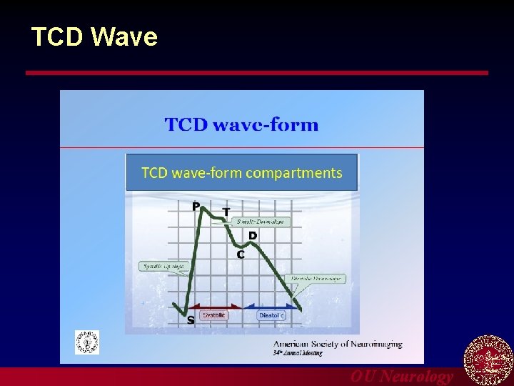 TCD Wave OU Neurology 