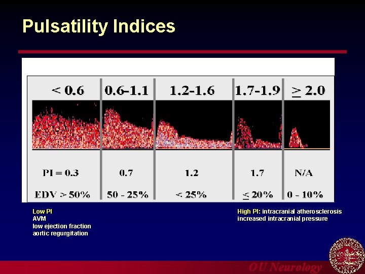 Pulsatility Indices Low PI AVM low ejection fraction aortic regurgitation High PI: intracranial atherosclerosis