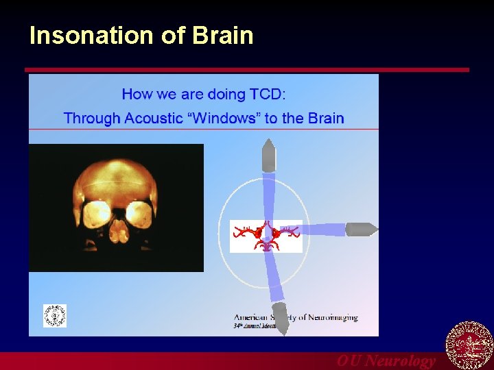 Insonation of Brain OU Neurology 