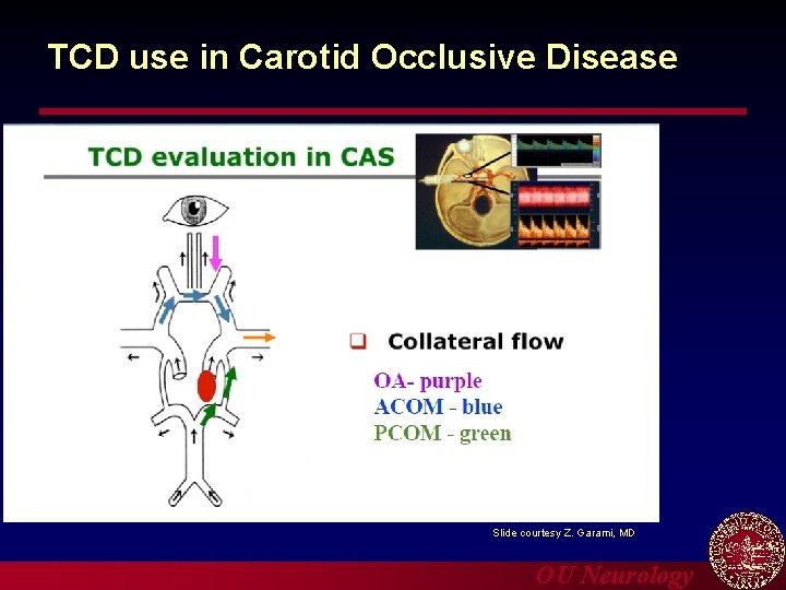 TCD use in Carotid Occlusive Disease Slide courtesy Z. Garami, MD OU Neurology 