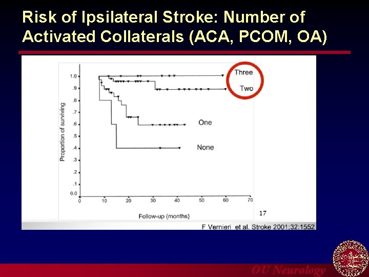 Risk of Ipsilateral Stroke: Number of Activated Collaterals (ACA, PCOM, OA) OU Neurology 