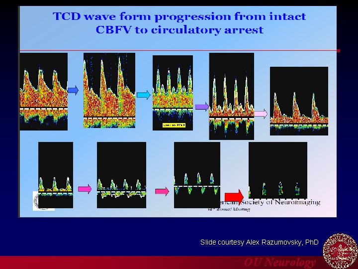 Diagnosis of Patent Foramen Ovale (PFO) Slide courtesy Alex Razumovsky, Ph. D OU Neurology