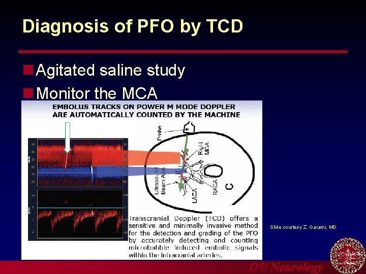 Diagnosis of PFO by TCD n Agitated saline study n Monitor the MCA Slide