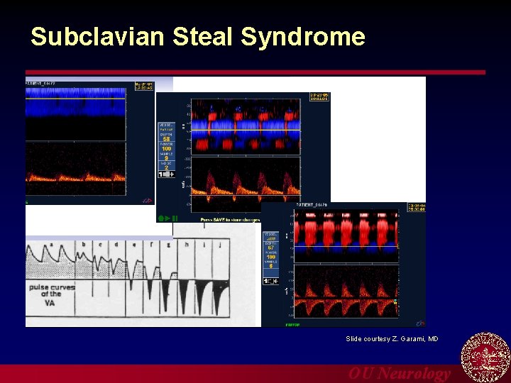Subclavian Steal Syndrome Slide courtesy Z. Garami, MD OU Neurology 