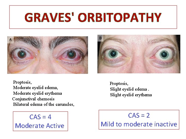 GRAVES' ORBITOPATHY Proptosis, Moderate eyelid edema, Moderate eyelid erythema Conjunctival chemosis Bilateral edema of GRAVES' ORBITOPATHY Proptosis, Moderate eyelid edema, Moderate eyelid erythema Conjunctival chemosis Bilateral edema of