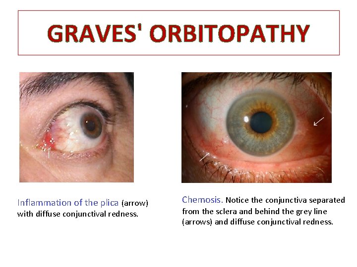 GRAVES' ORBITOPATHY Inflammation of the plica (arrow) with diffuse conjunctival redness. Chemosis. Notice the GRAVES' ORBITOPATHY Inflammation of the plica (arrow) with diffuse conjunctival redness. Chemosis. Notice the