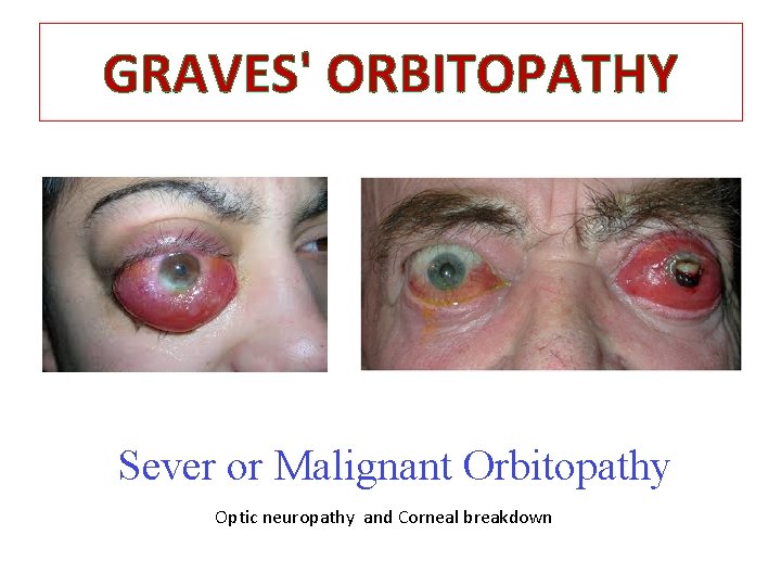 GRAVES' ORBITOPATHY Sever or Malignant Orbitopathy Optic neuropathy and Corneal breakdown GRAVES' ORBITOPATHY Sever or Malignant Orbitopathy Optic neuropathy and Corneal breakdown