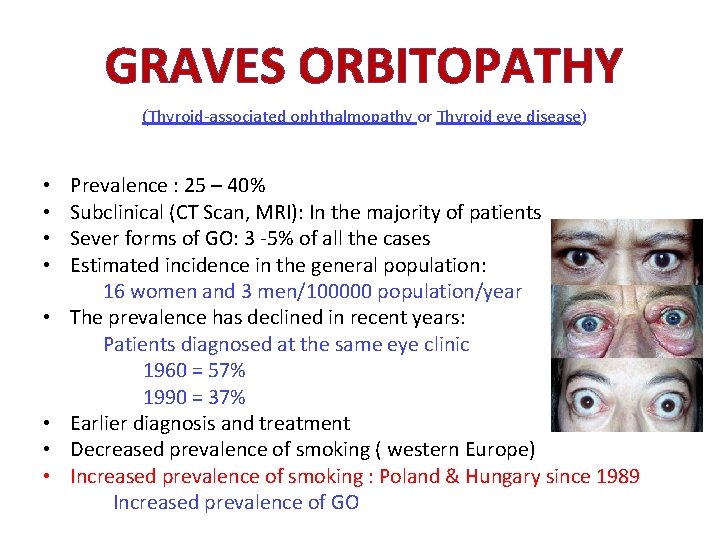 GRAVES ORBITOPATHY (Thyroid-associated ophthalmopathy or Thyroid eye disease) • • Prevalence : 25 – GRAVES ORBITOPATHY (Thyroid-associated ophthalmopathy or Thyroid eye disease) • • Prevalence : 25 –