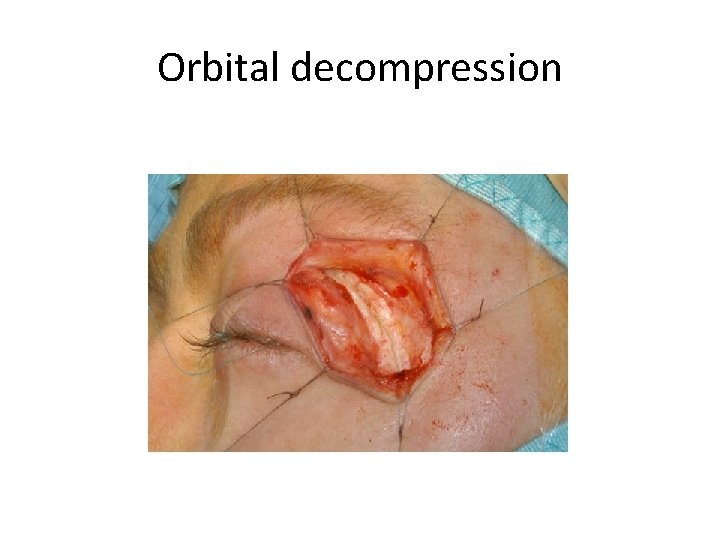 Orbital decompression Orbital decompression