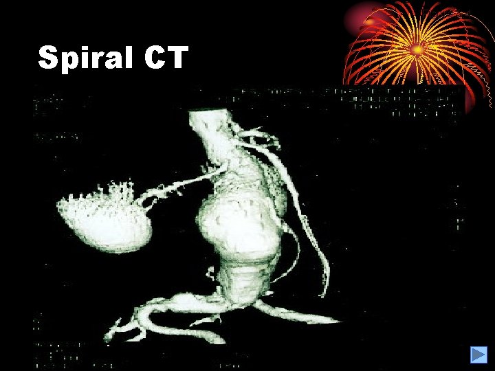 Figure 8. 4 Spiral CT 