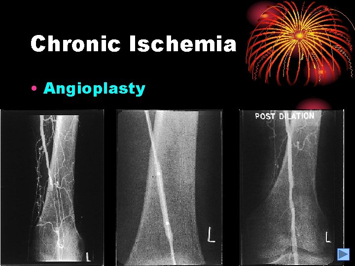 Figure 3. 8 Chronic Ischemia • Angioplasty 
