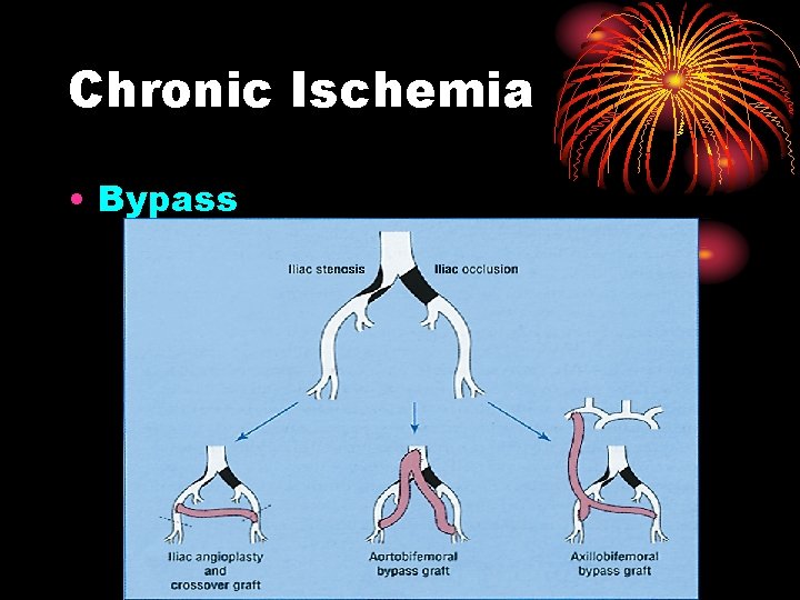 Chronic Ischemia • Bypass 