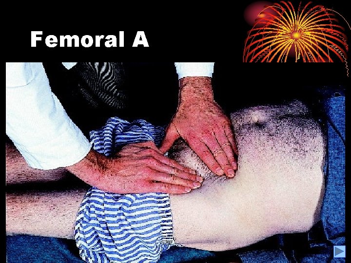 Figure 3. 1 Femoral A 