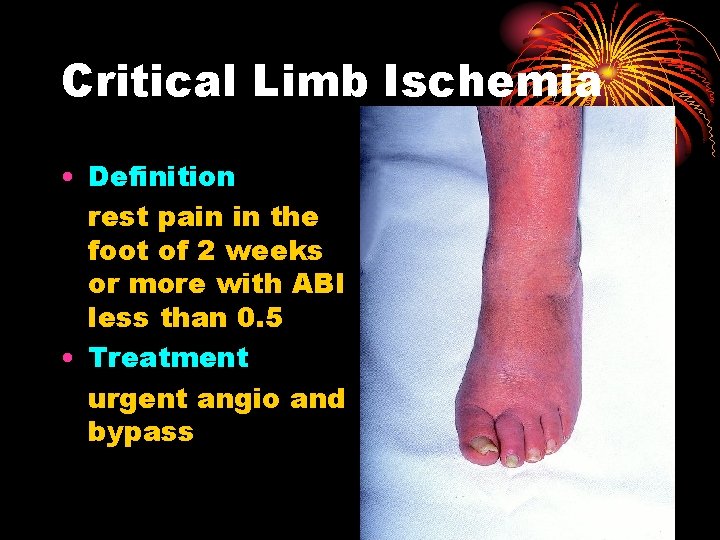 Critical Limb Ischemia • Definition rest pain in the foot of 2 weeks or