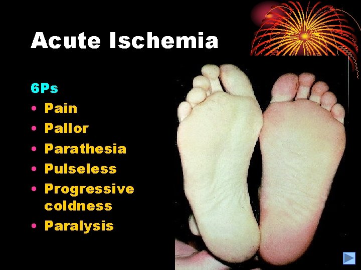 Figure 2. 1 Acute Ischemia 6 Ps • Pain • Pallor • Parathesia •