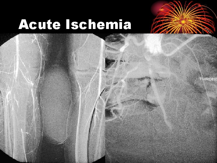 Figure 2. 2 Acute Ischemia 