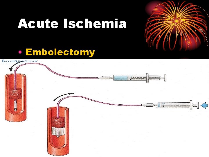 Acute Ischemia • Embolectomy 